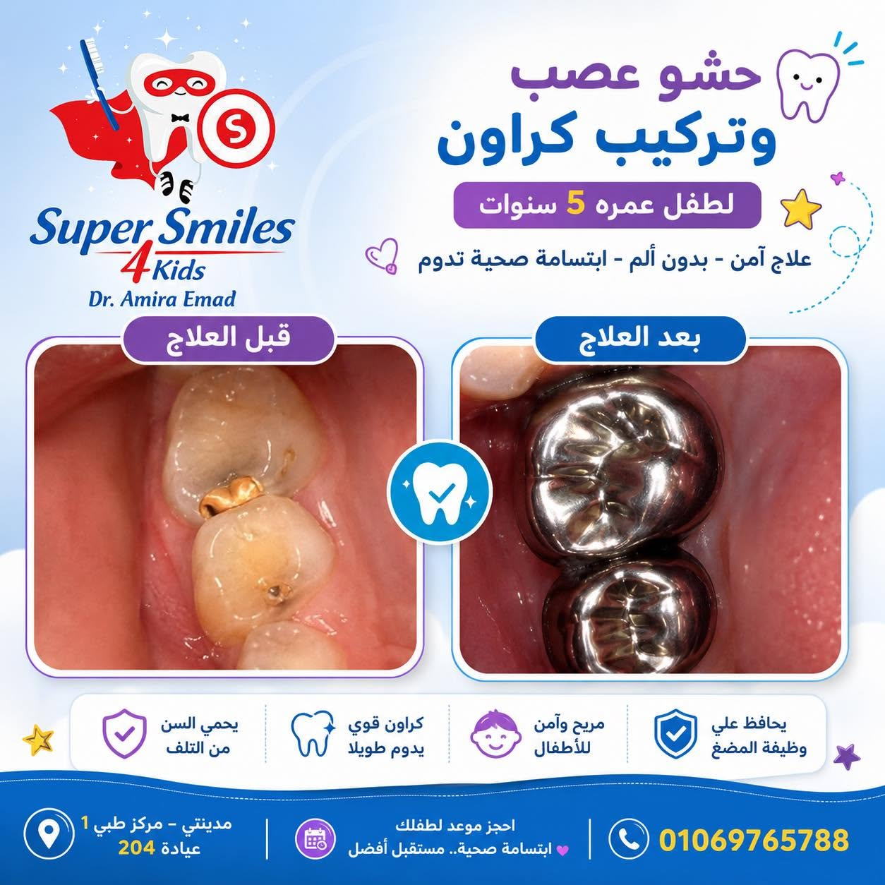 Before and after pediatric pulp therapy and stainless-steel crowns